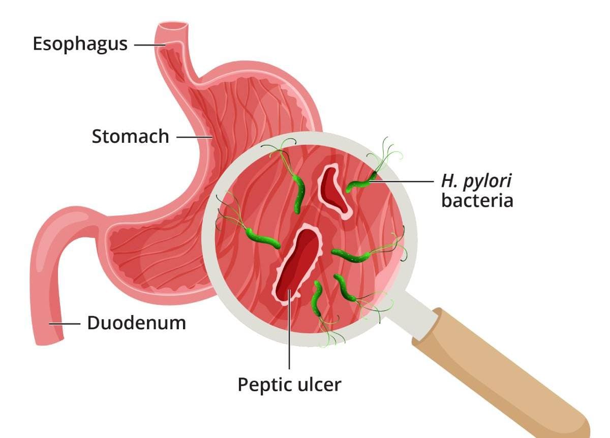 পেটের ক্যানসার বাড়ছে দ্রুত চিকিৎসকরা জানালেন চমকে দেওয়া কারণ