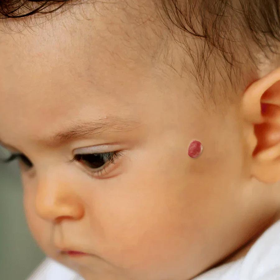 শিশুর ত্বকে লালচে উঁচু দাগ  হতে পারে হেমানজিয়োমা সাবধান থাকুন 