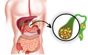 গলব্লাডারে পাথর জমার লক্ষণ ও খাবার যা বাড়াতে পারে রোগ